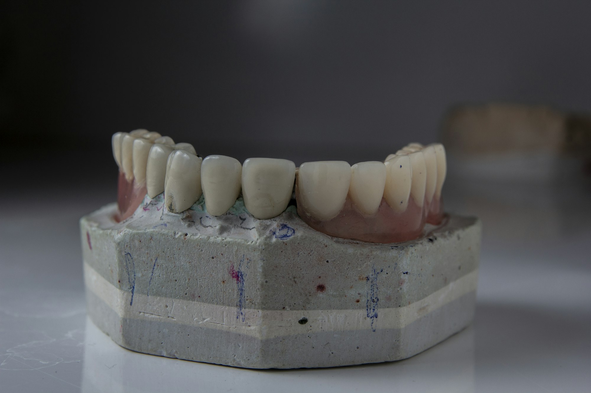 Dental model with a full row of restored teeth