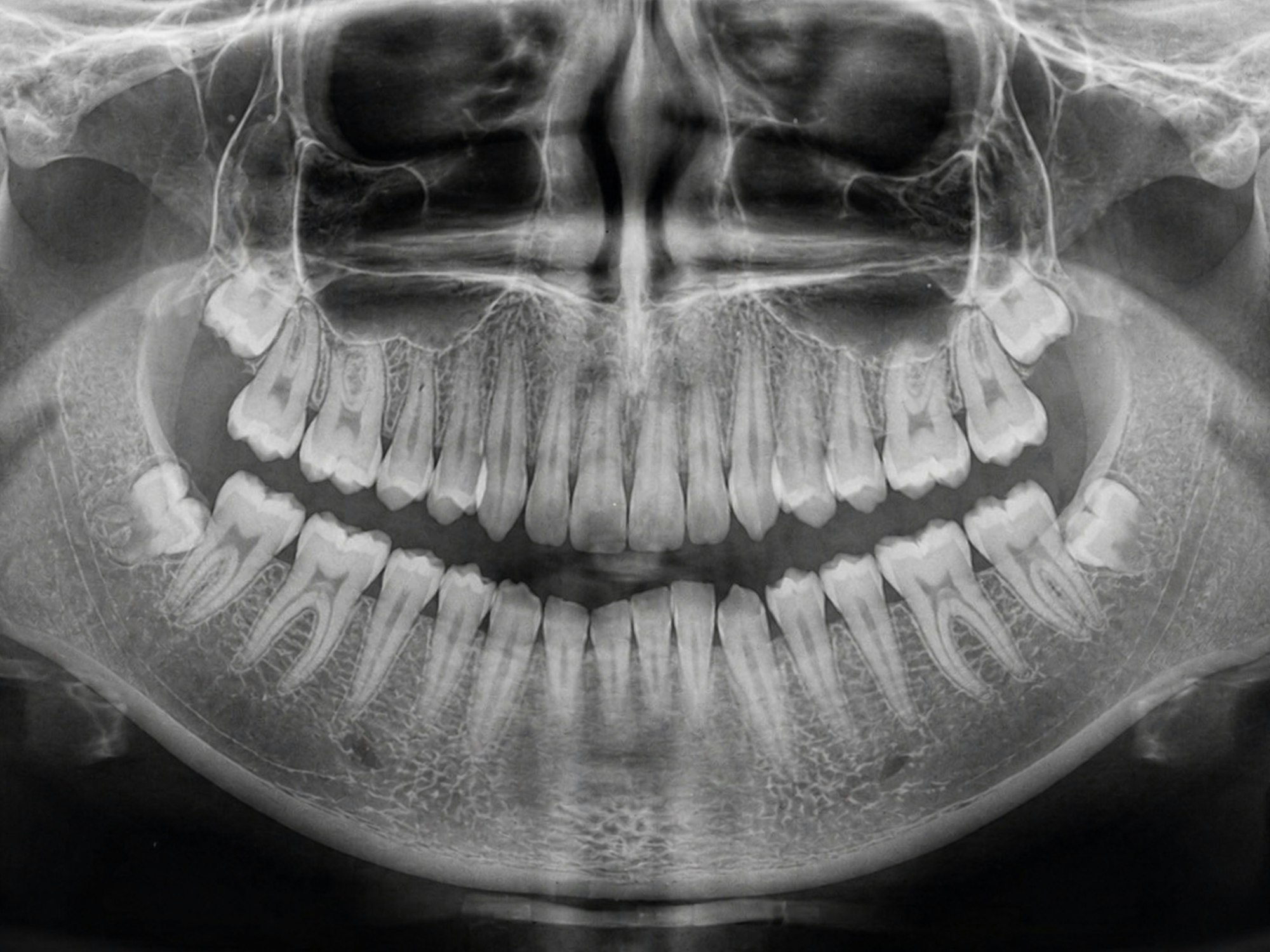 Panoramic dental x-ray showing the teeth and jawbone